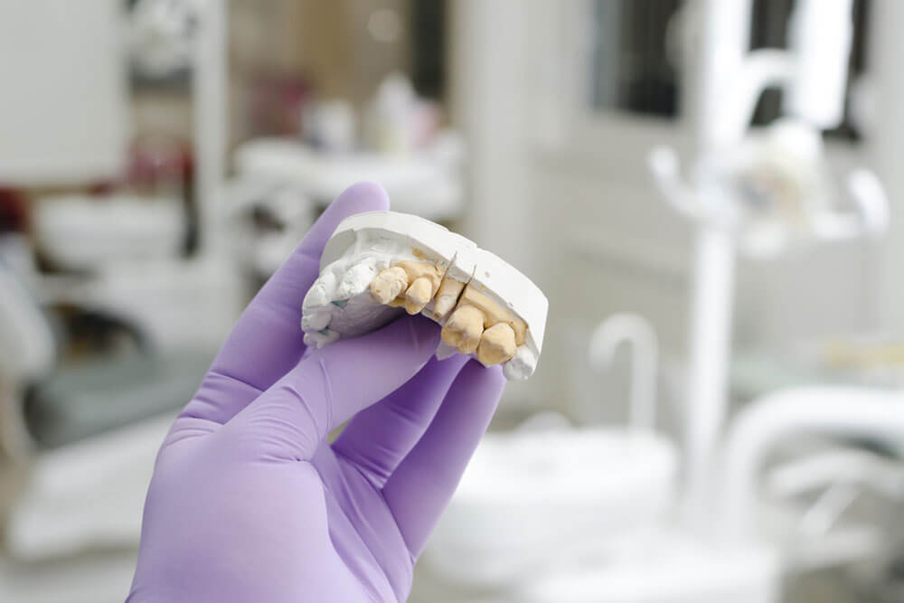 PFM Restorations - CBI Dental Lab
